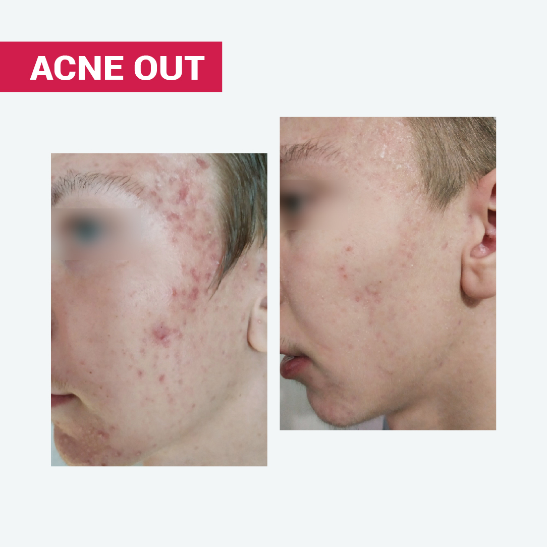 АКТИВНИЙ КРЕМ ACNE OUT / ДЛЯ ПРОБЛЕМНОЇ ШКІРИ З ВУГРАМИ ТА КОМЕДОНАМИ / ЛОКАЛЬНОГО НАНЕСЕННЯ 30 МЛ - Image 9