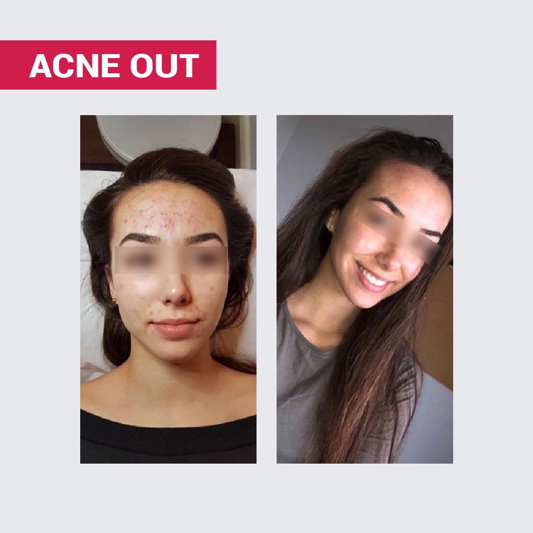 АКТИВНИЙ КРЕМ ACNE OUT / ДЛЯ ПРОБЛЕМНОЇ ШКІРИ З ВУГРАМИ ТА КОМЕДОНАМИ / ЛОКАЛЬНОГО НАНЕСЕННЯ 30 МЛ - Image 10