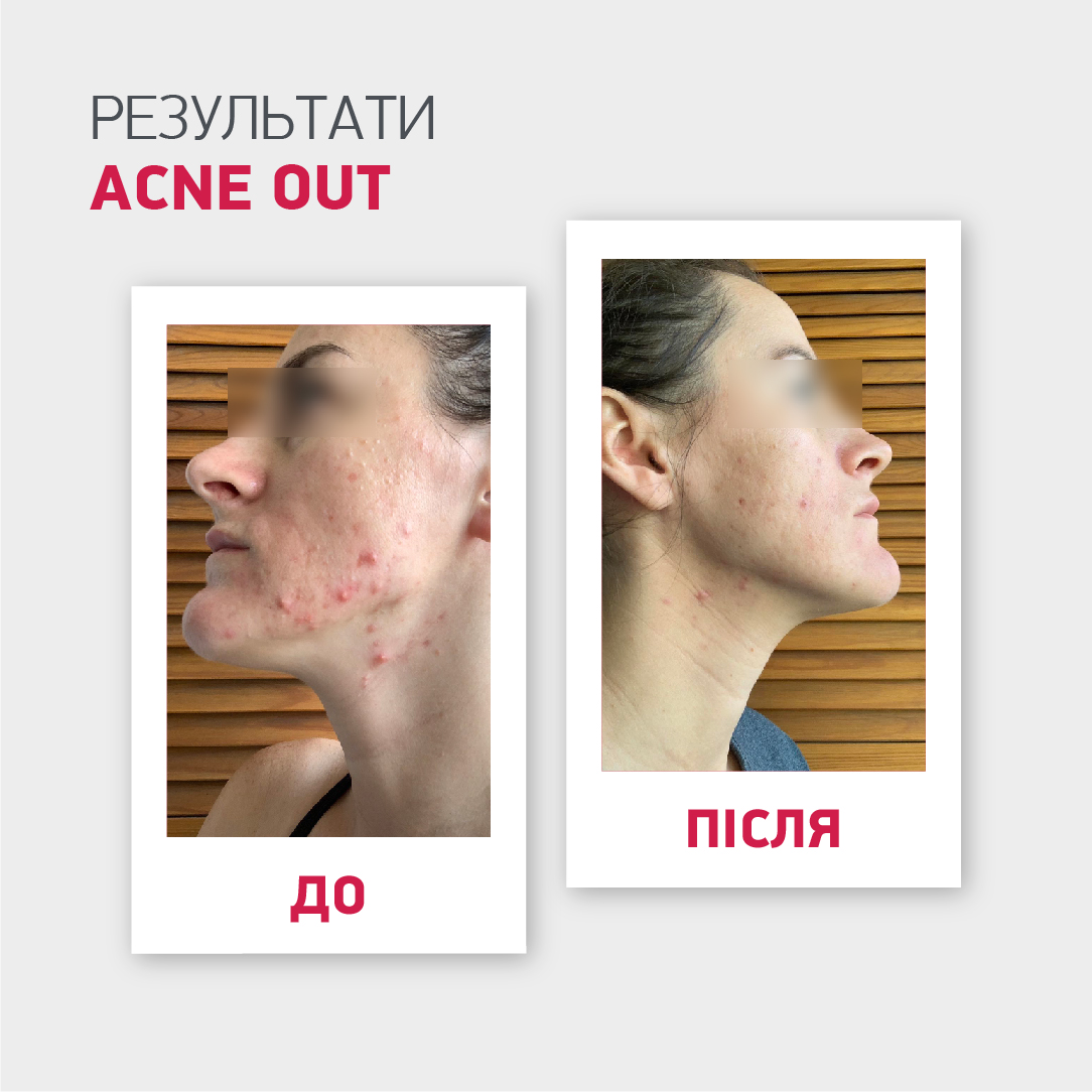 АКТИВНИЙ ЛОСЬЙОН ACNE OUT / ДЛЯ ПРОБЛЕМНОЇ ШКІРИ З ЗАПАЛЬНИМИ ФОРМАМИ АКНЕ / ЛОКАЛЬНОГО НАНЕСЕННЯ 60 мл - Image 8