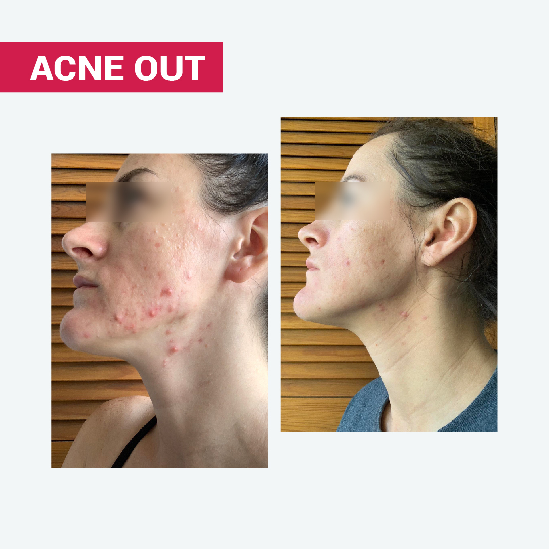 АКТИВНИЙ ЛОСЬЙОН ACNE OUT / ДЛЯ ПРОБЛЕМНОЇ ШКІРИ З ЗАПАЛЬНИМИ ФОРМАМИ АКНЕ / ЛОКАЛЬНОГО НАНЕСЕННЯ / МІНІ-ФОРМАТ 10 мл - Image 10