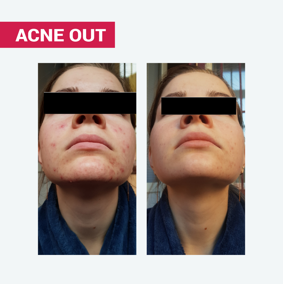 АКТИВНИЙ ЛОСЬЙОН ACNE OUT / ДЛЯ ПРОБЛЕМНОЇ ШКІРИ З ЗАПАЛЬНИМИ ФОРМАМИ АКНЕ / ЛОКАЛЬНОГО НАНЕСЕННЯ / МІНІ-ФОРМАТ 10 мл - Image 9