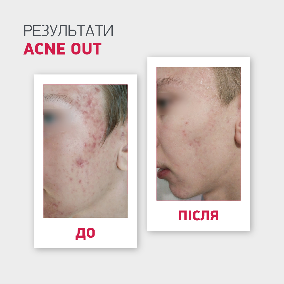 МАТУЮЧИЙ ТОНІК ACNE OUT / ДЛЯ ЖИРНОЇ ШКІРИ ТА ПРИ ЛЕГКИХ ФОРМАХ АКНЕ 60 МЛ - Image 9