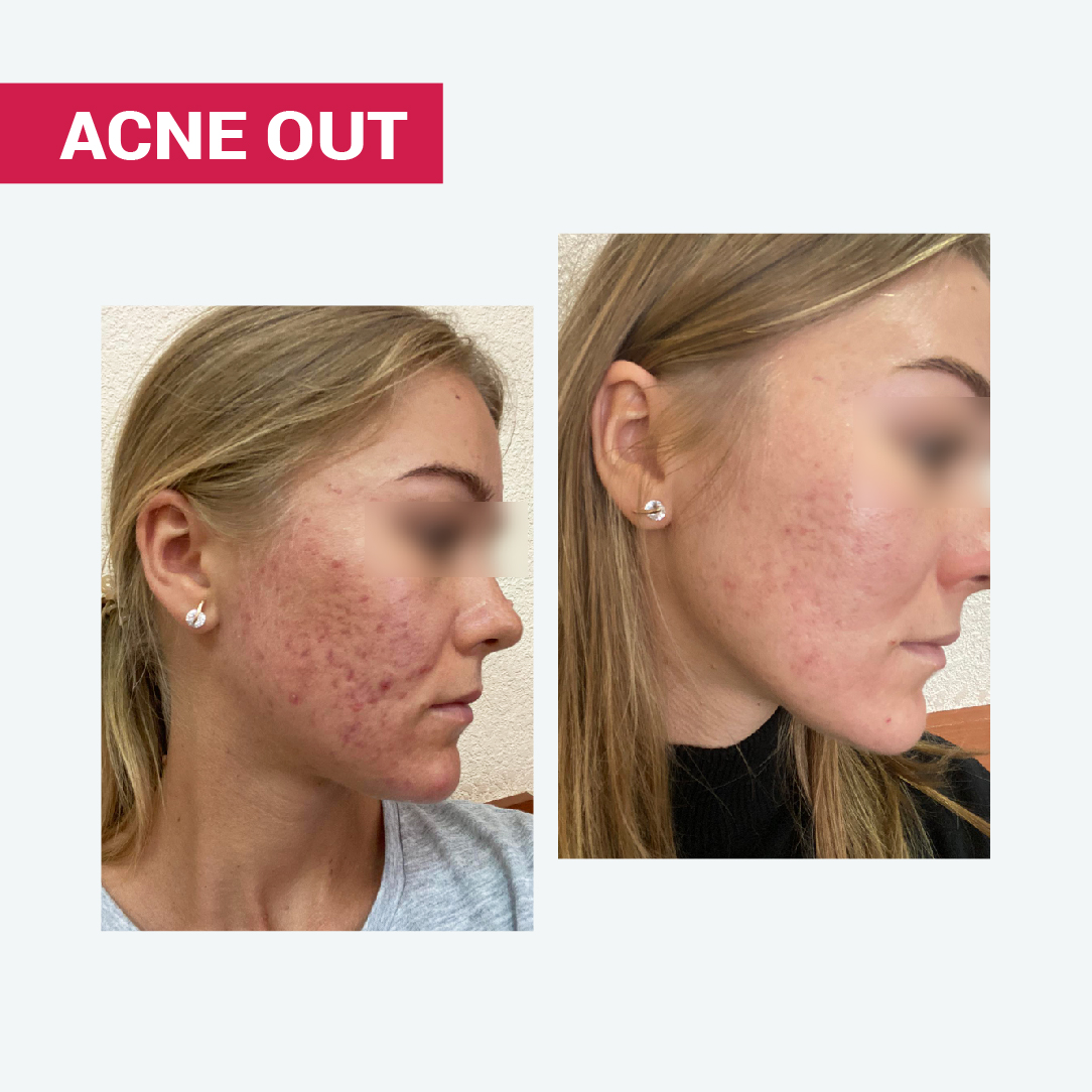 НАТУРАЛЬНЕ МИЛО ACNE OUT / ДЛЯ ЖИРНОЇ ТА ПРОБЛЕМНОЇ ШКІРИ ОБЛИЧЧЯ ТА ТІЛА 100 г - Image 9