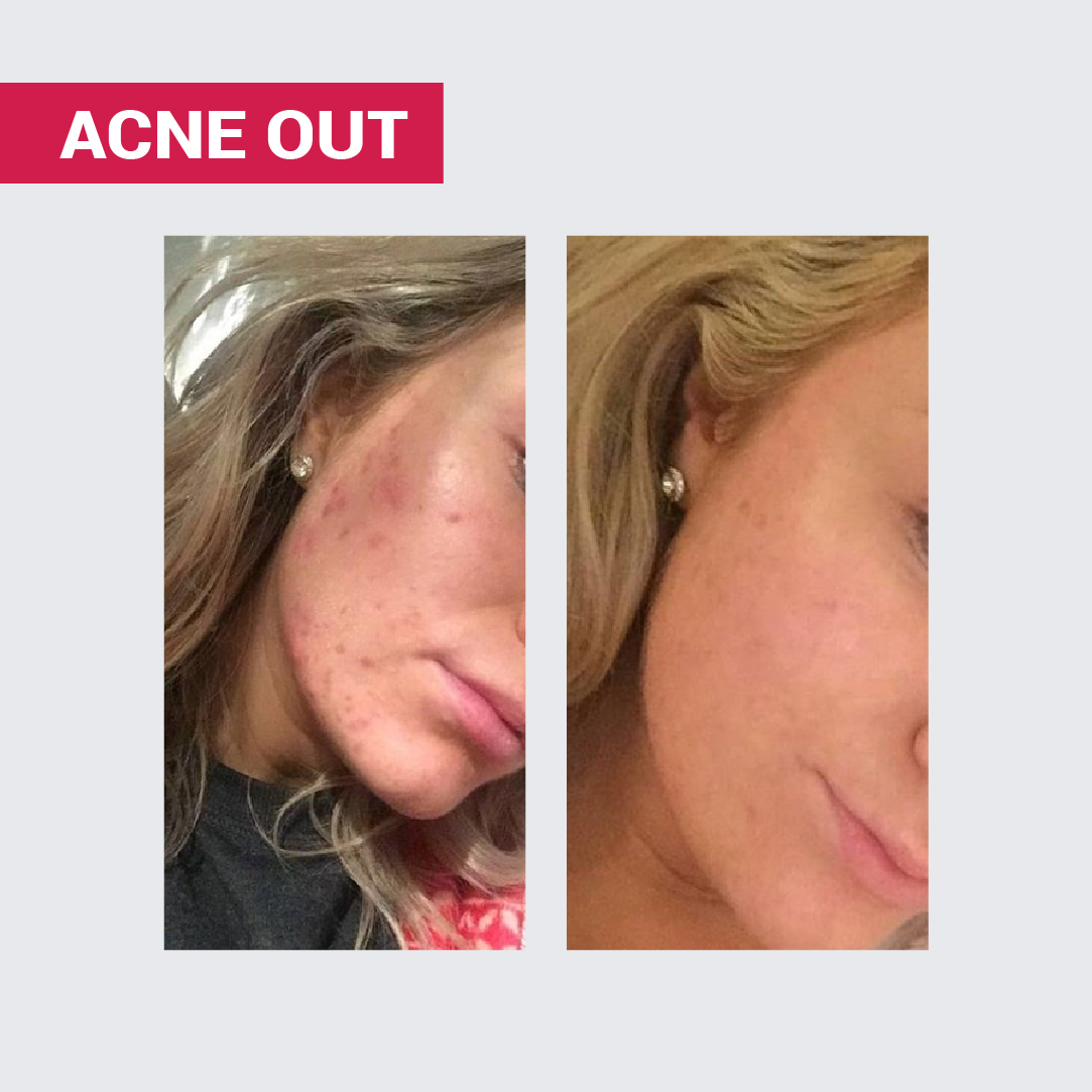 НАТУРАЛЬНЕ МИЛО ACNE OUT / ДЛЯ ЖИРНОЇ ТА ПРОБЛЕМНОЇ ШКІРИ ОБЛИЧЧЯ ТА ТІЛА 100 г - Image 8