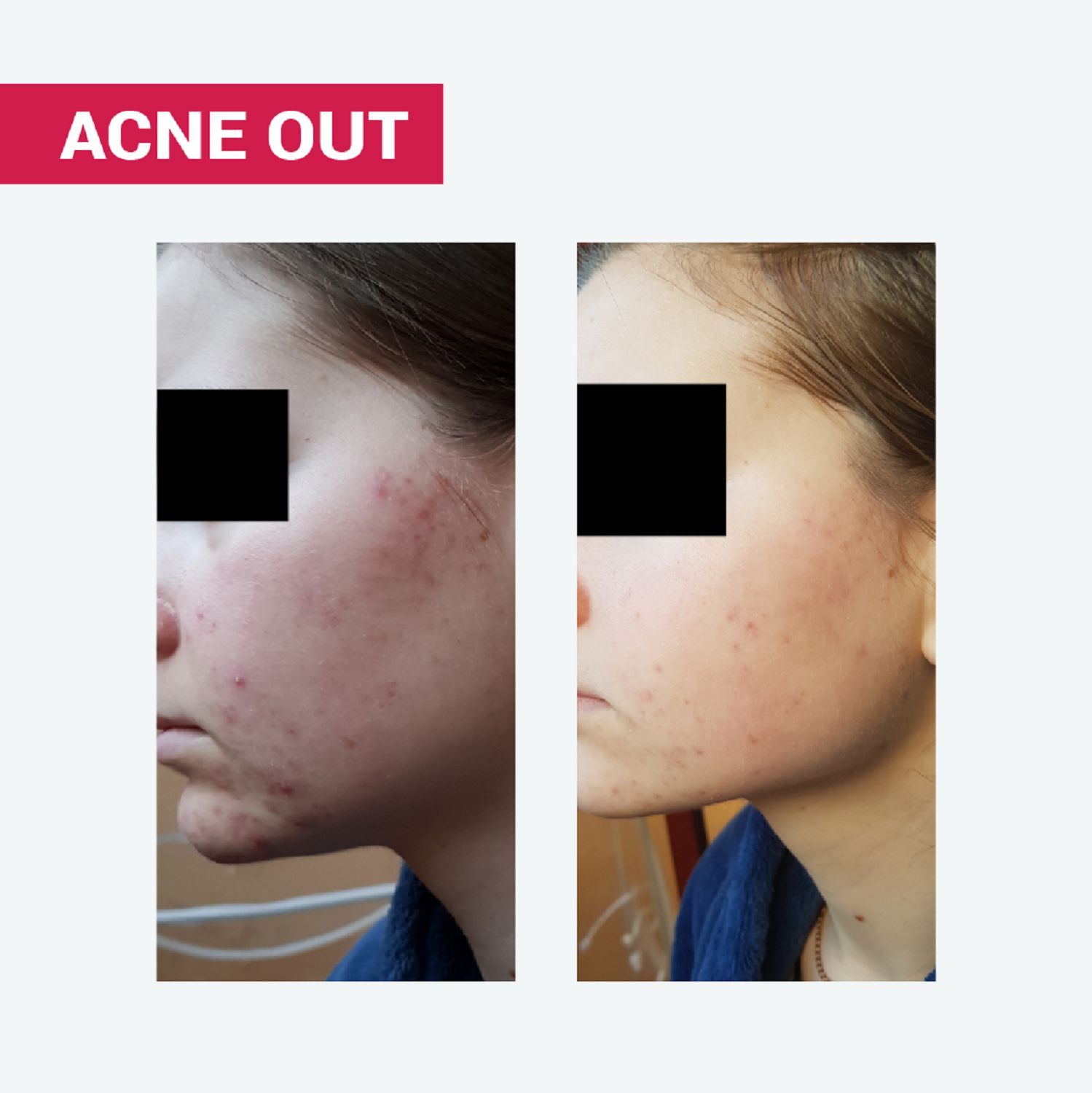 НІЖНА ПІНА ACNE OUT З МОЛОЧНОЮ КИСЛОТОЮ / ДЛЯ ОЧИЩЕННЯ КОМБІНОВАНОЇ ТА СХИЛЬНОЇ ДО АКНЕ ШКІРИ 150 мл - Image 2