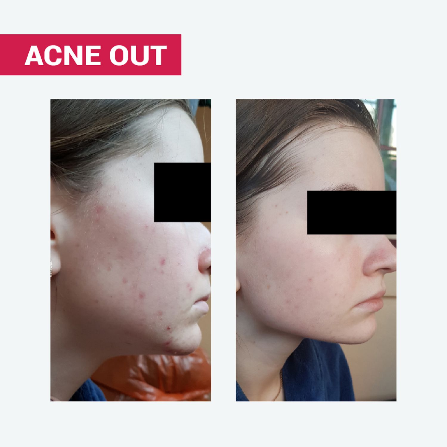 НІЖНА ПІНА ACNE OUT З МОЛОЧНОЮ КИСЛОТОЮ / ДЛЯ ОЧИЩЕННЯ КОМБІНОВАНОЇ ТА СХИЛЬНОЇ ДО АКНЕ ШКІРИ 150 мл - Image 3