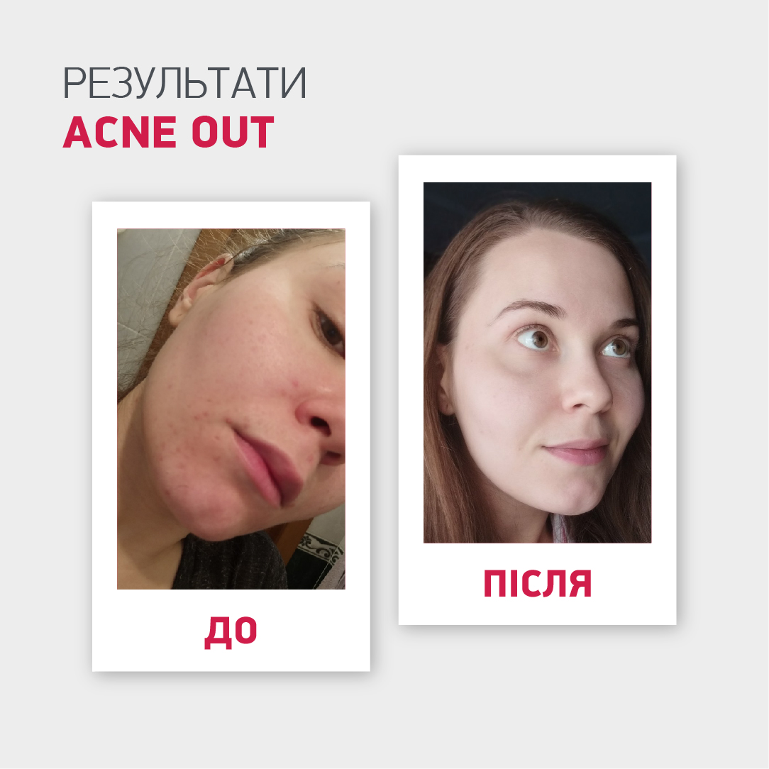 ВІДНОВЛЮВАЛЬНИЙ КРЕМ З SPF 30 ACNE OUT / ДЛЯ ШКІРИ З ВИДИМИМИ ДЕФЕКТАМИ ТА ПЛЯМАМИ ПОСТАКНЕ 30 МЛ - Image 8