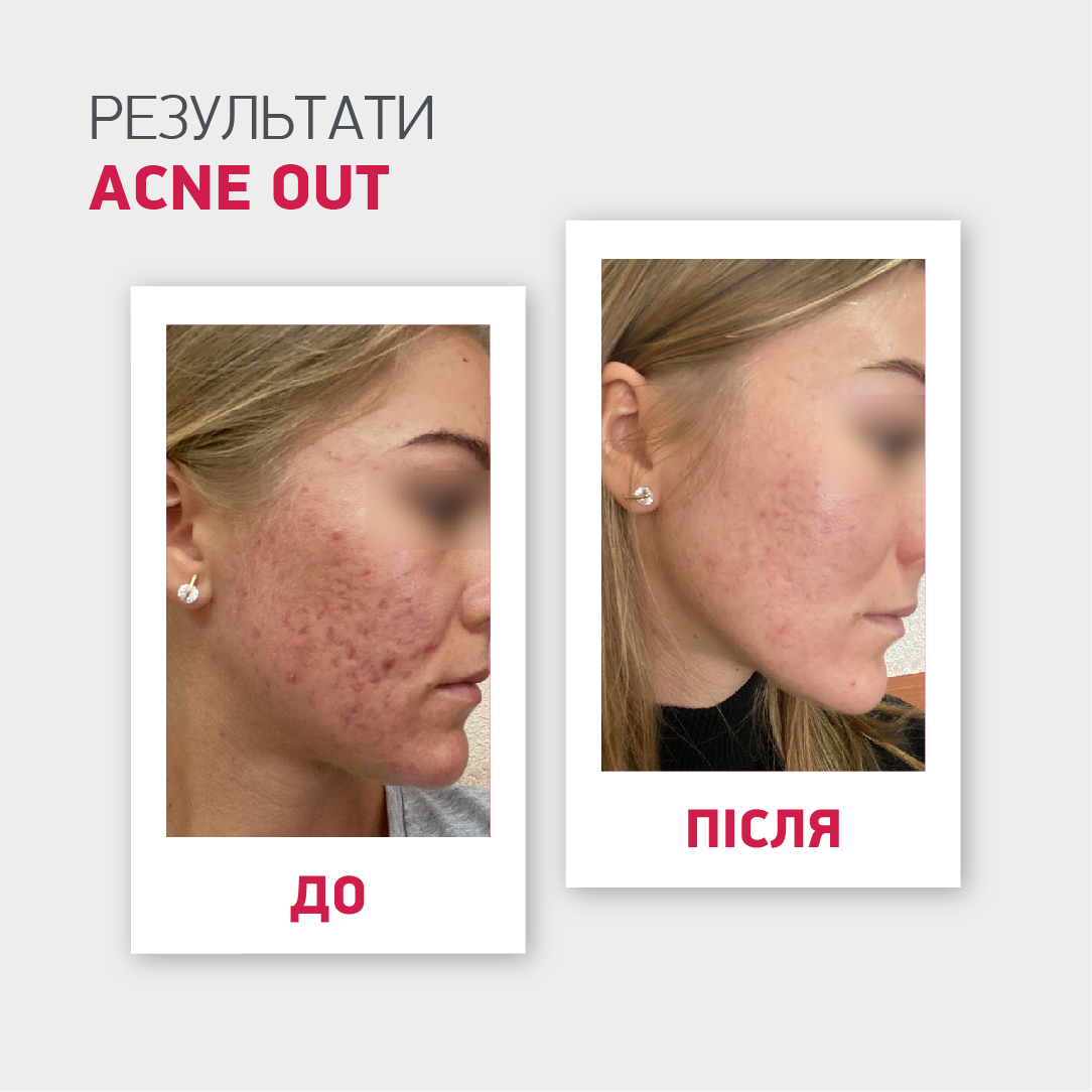 ВІДНОВЛЮВАЛЬНИЙ КРЕМ З SPF 30 ACNE OUT / ДЛЯ ШКІРИ З ВИДИМИМИ ДЕФЕКТАМИ ТА ПЛЯМАМИ ПОСТАКНЕ 30 МЛ - Image 9