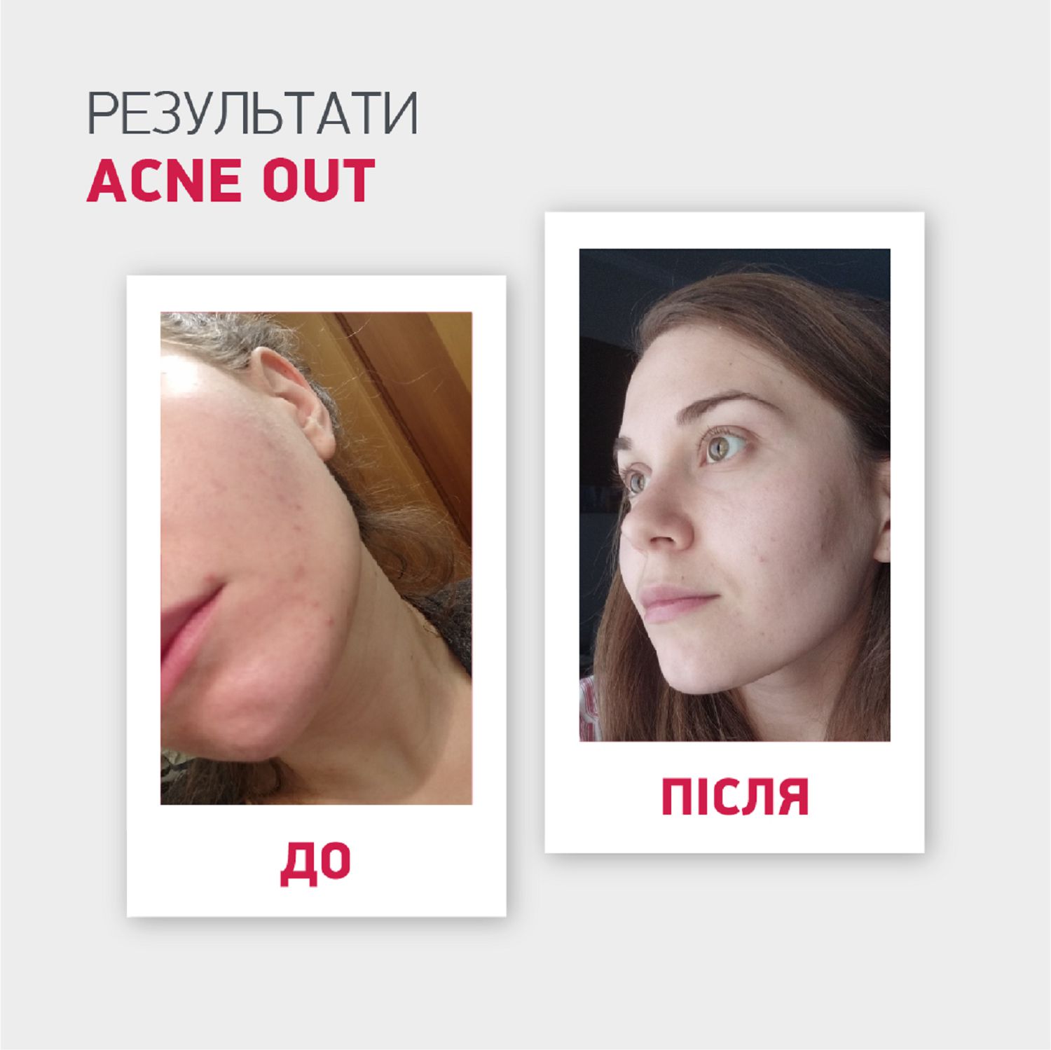 ЗВОЛОЖУВАЛЬНИЙ КРЕМ "ГІДРО АКТИВ" ACNE OUT 60 мл - Image 8