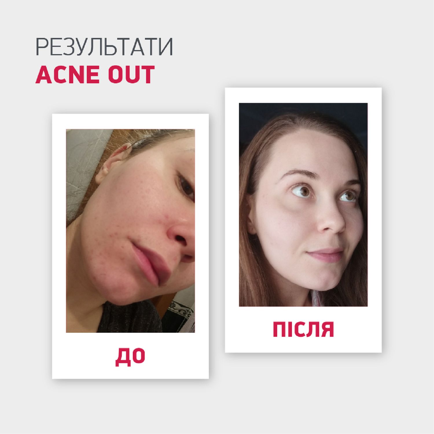 ЗВОЛОЖУВАЛЬНИЙ КРЕМ "ГІДРО АКТИВ" ACNE OUT 60 мл - Image 9